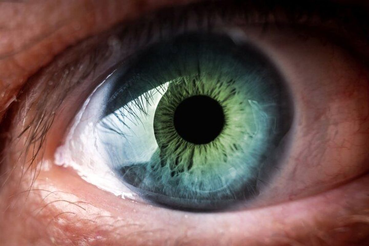 ردپای اثر کرونا اومیکرون روی چشم ها   خارش چشم از نشانه های اومیکرون