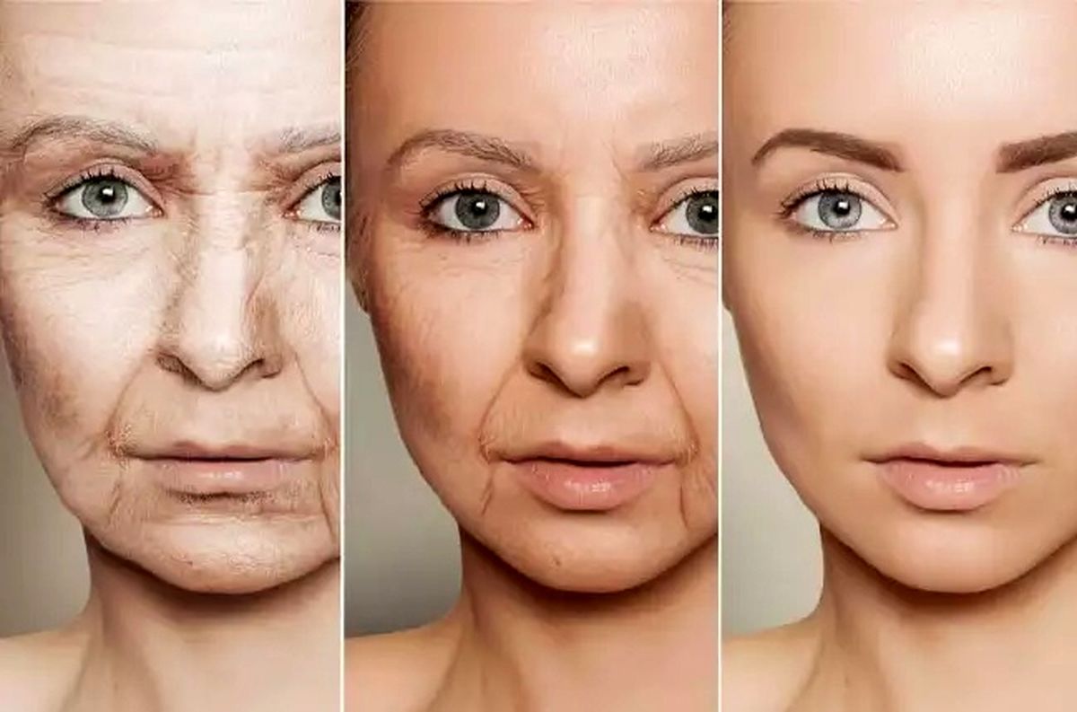 شکلگیری چینوچروک پوستی دقیقا از چه سنی شروع میشود؟