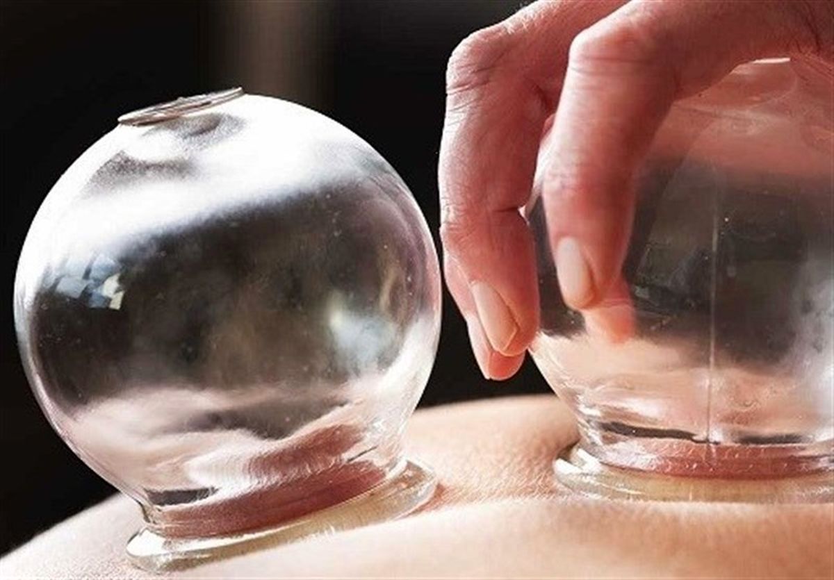۲۴ اثر و فایده مهم انجام حجامت بر سلامت بدن