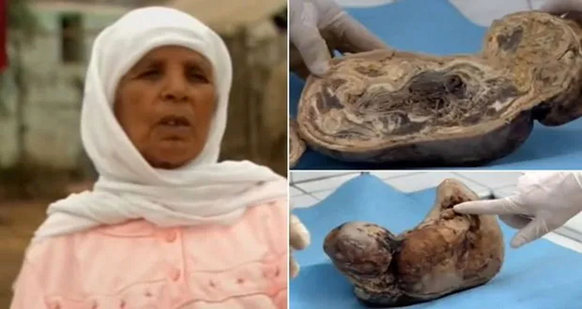 به دنیا آمدن نوزاد سنگی از یک زن پس از ۴۵ سال! +تصاویر
