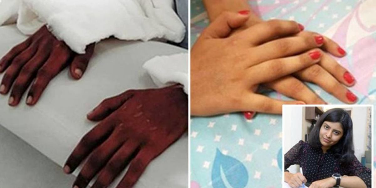 دستان یک مرد پس از پیوند به دستان یک زن کاملا زنانه شد! +تصاویر