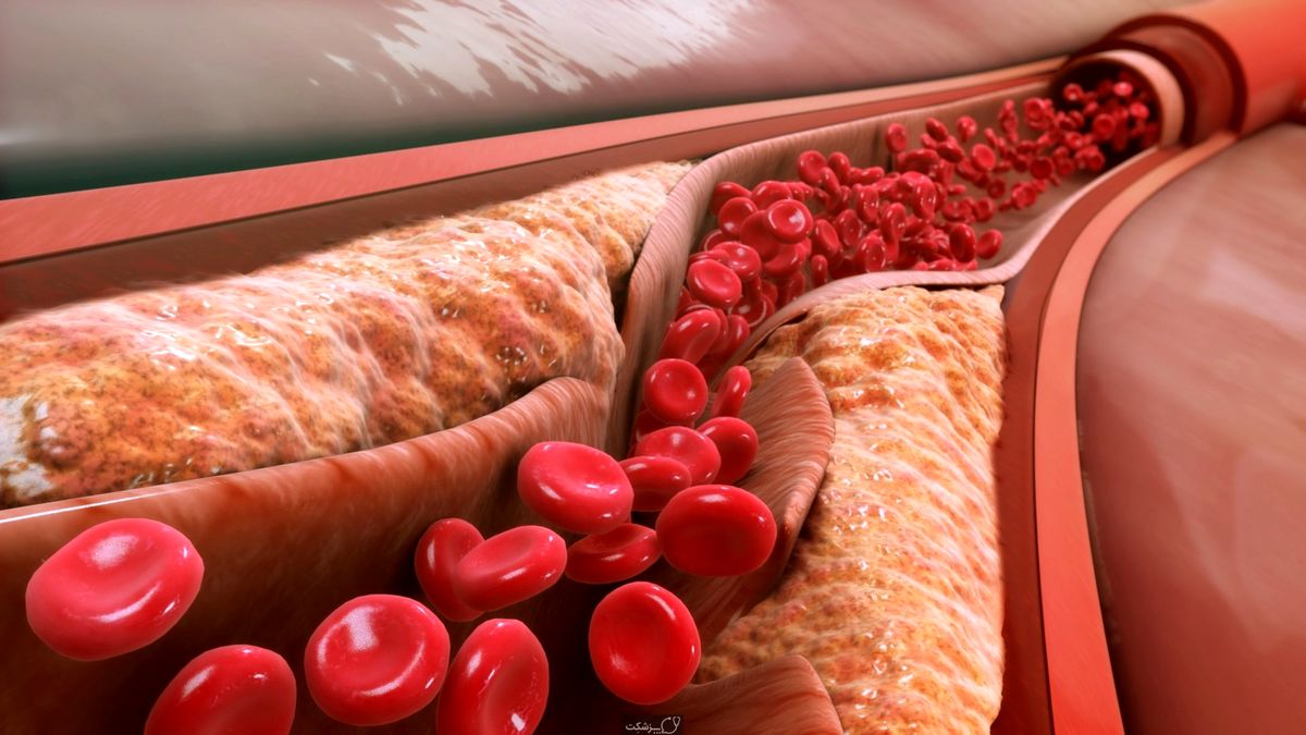 کدام خوراکی‌ها کلسترول خون را پایین می‌آورند؟