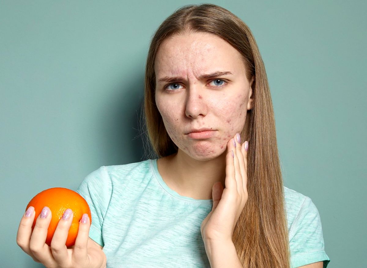 آیا مصرف پرتقال برای جوش و آکنه خوب است؟
