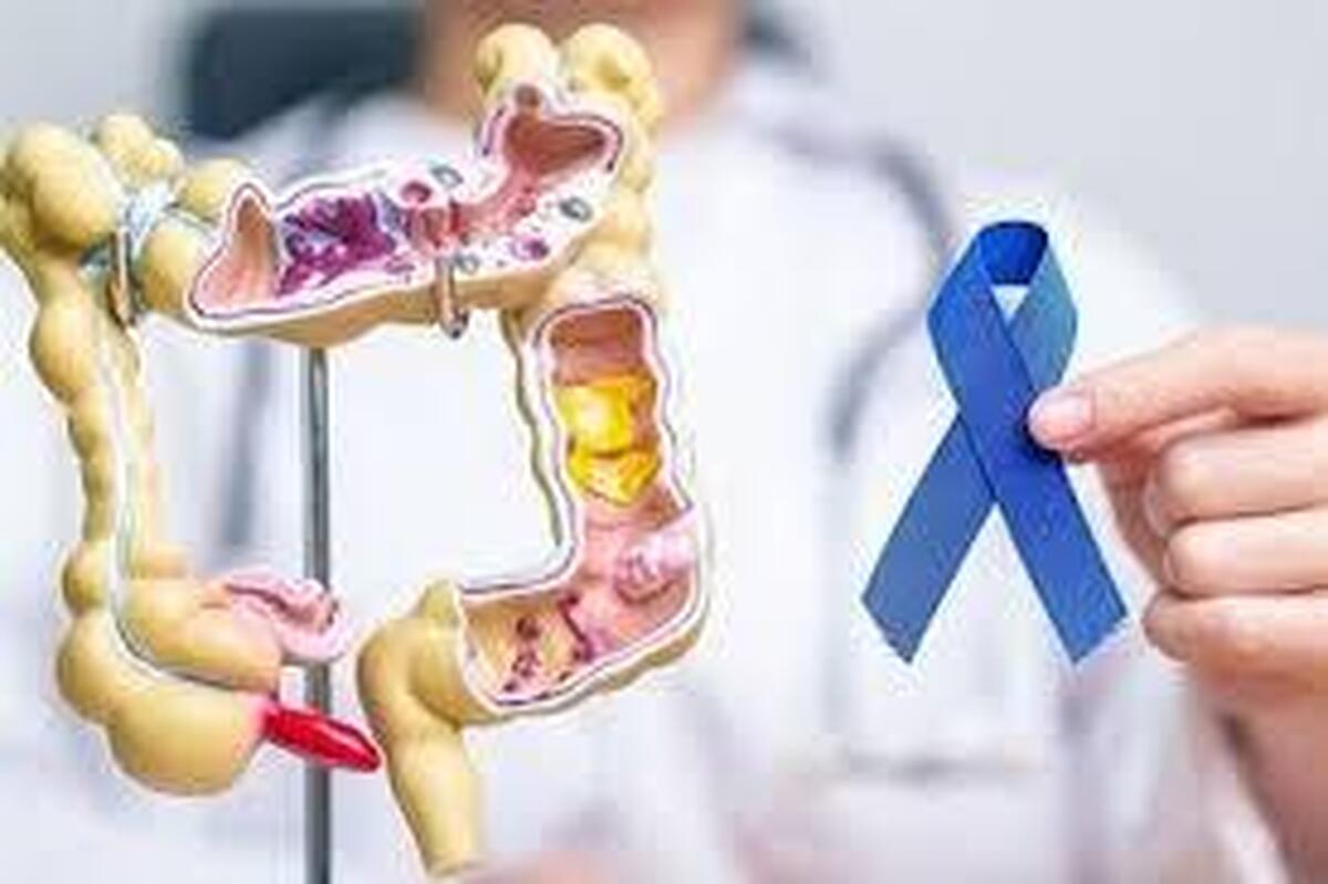 یافته‌های جدید درباره سرطان روده