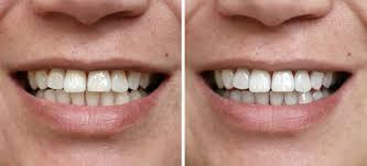 روش‌های بلیچینگ دندان و مراقبت‌های ضروری قبل و بعد از آن