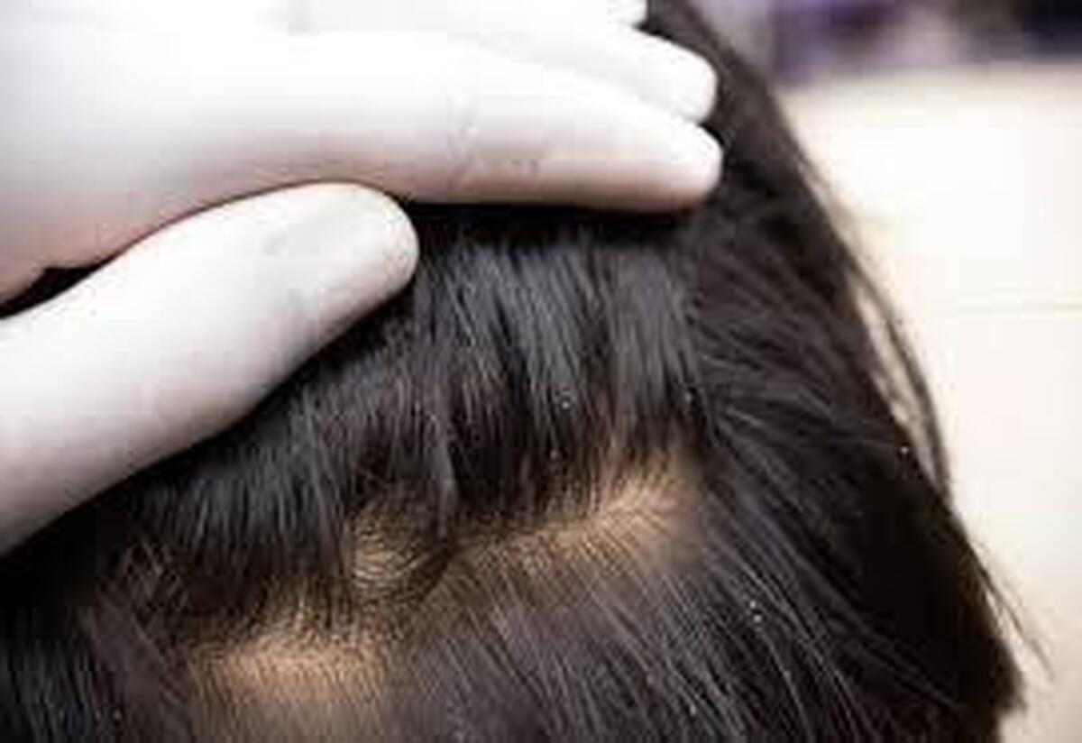 طاسی ارثی معمولاً از چه سنی آغاز می‌شود؟