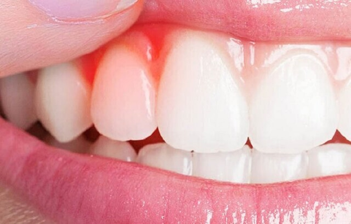 کیفیت خواب ضعیف، رهاورد بیماریهای لثه